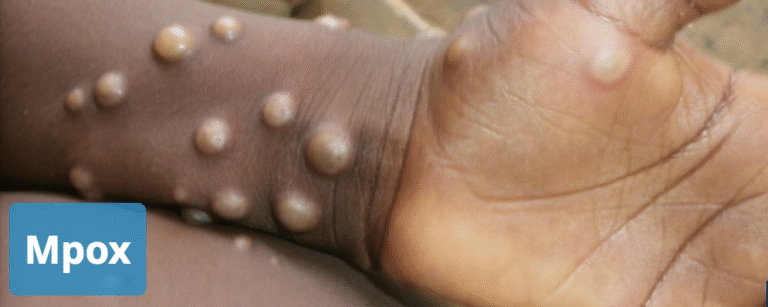 MPox, A Wake-Up Call, Not A Panic Button